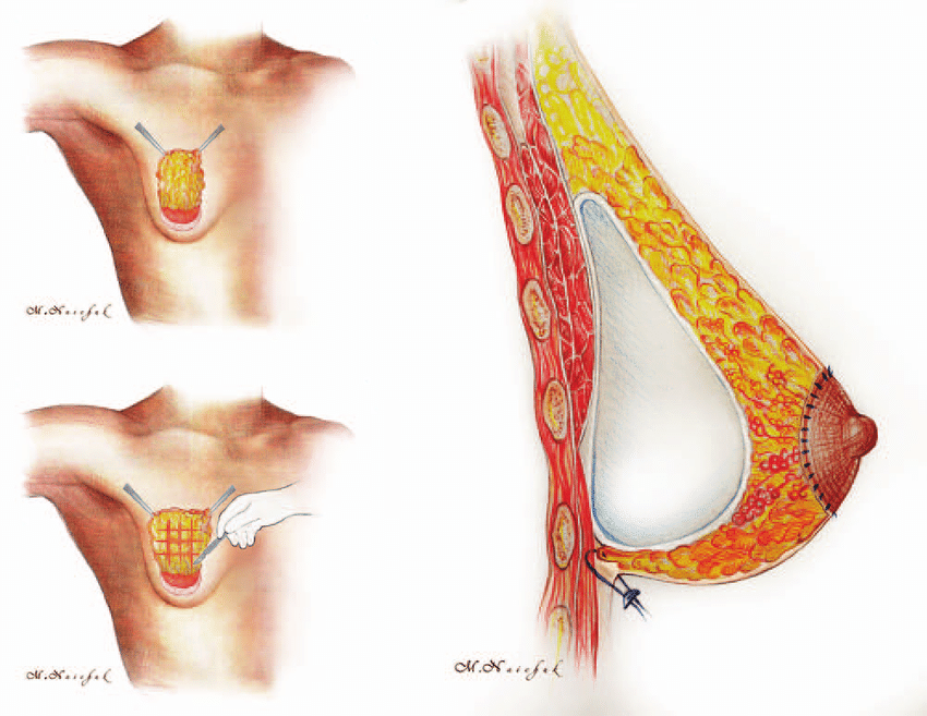 What are Tubular Breasts? - Fix Tuberous Breasts Scottsdale AZ