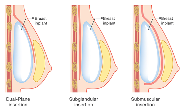 2023 What is Breast Augmentation? Definition of Breast Aug Surgery
