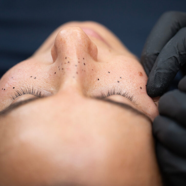 patient receiving freckle tattooing