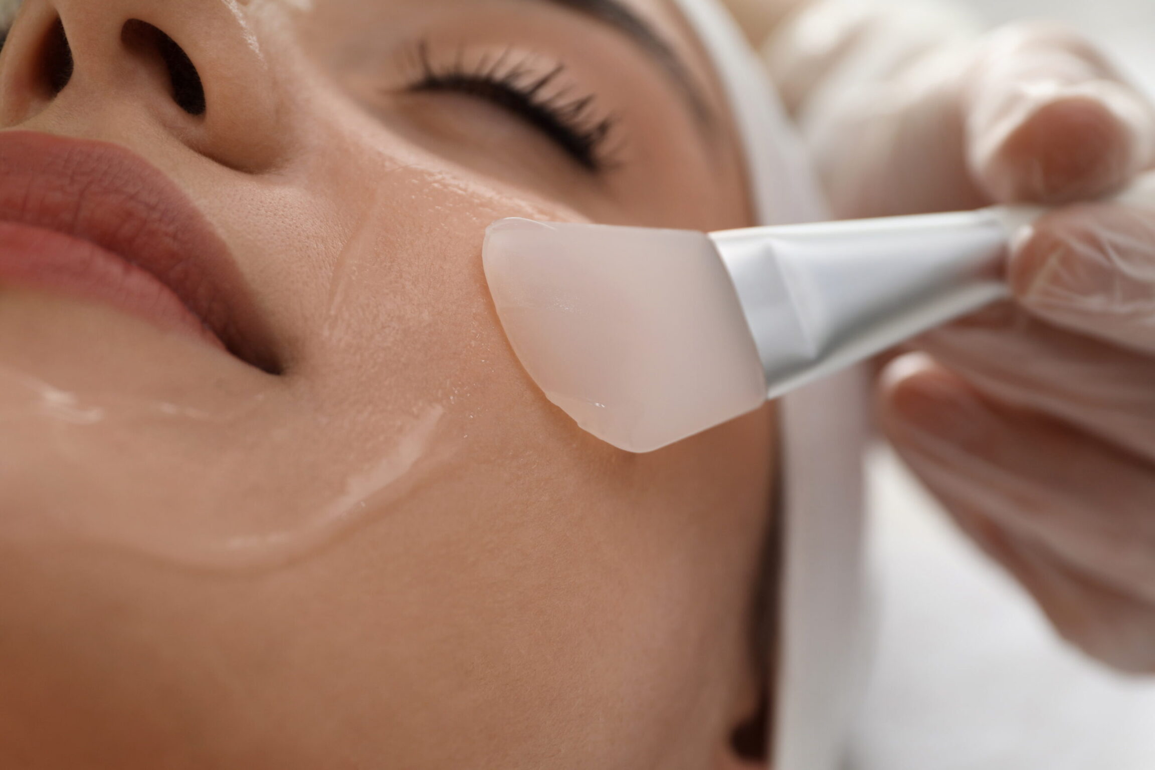 Patient receiving a chemical peel